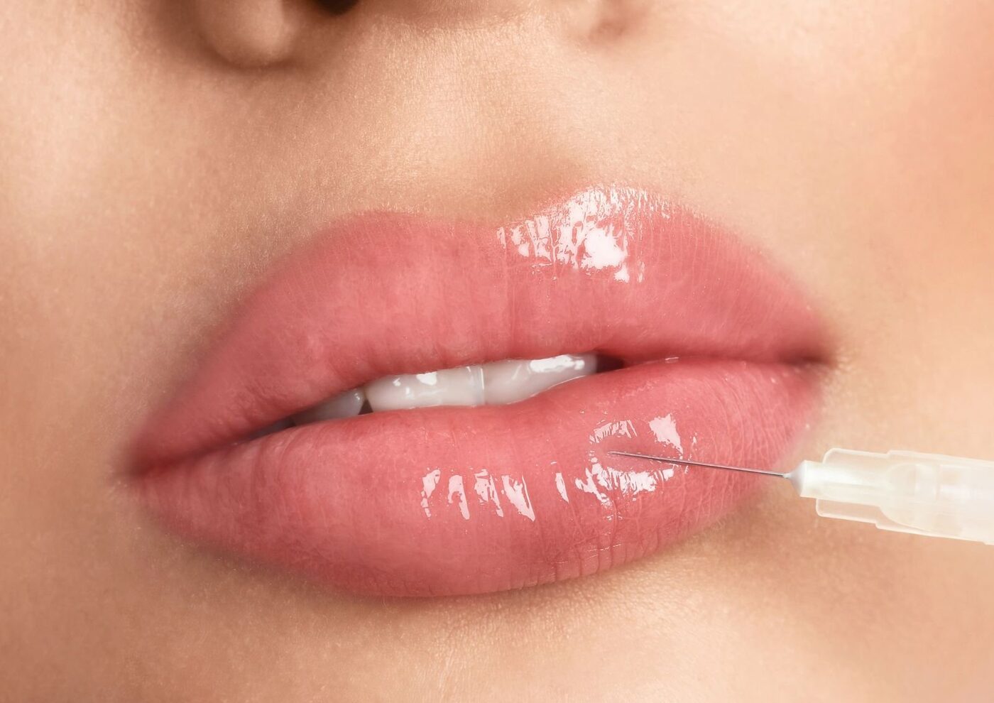 Close-up of natural lip and cheek enhancement,dermal filler treatment results