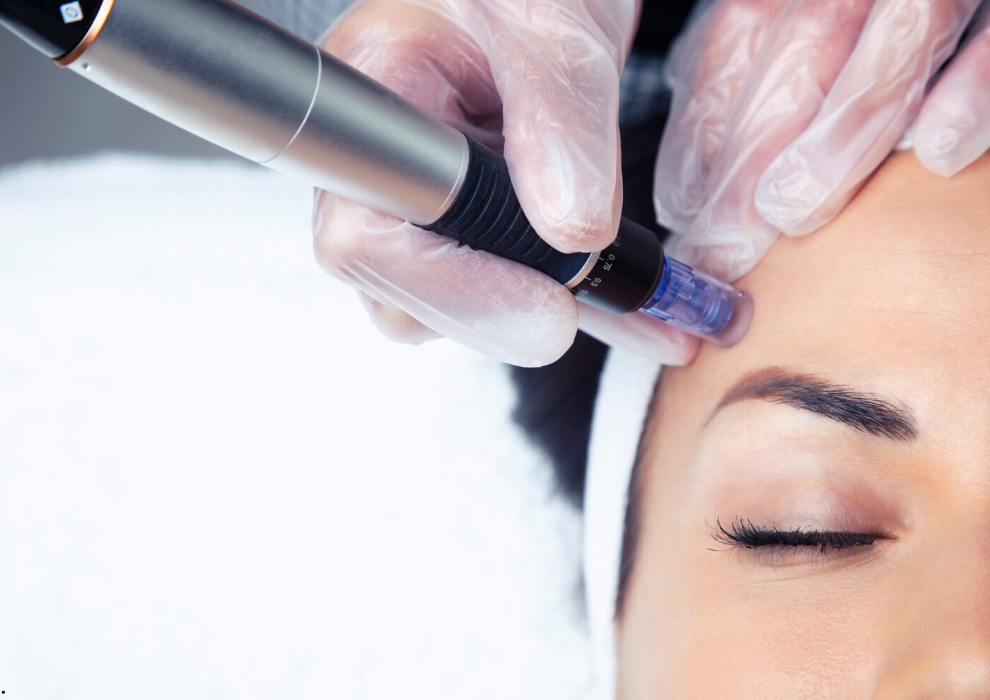 Microneedling collagen induction therapy,skin texture and rejuvenation